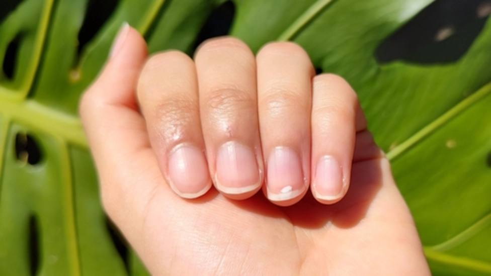 Las alteraciones y manchas persistentes en las uñas pueden avisar de la  presencia de enfermedades cutáneas u orgánicas