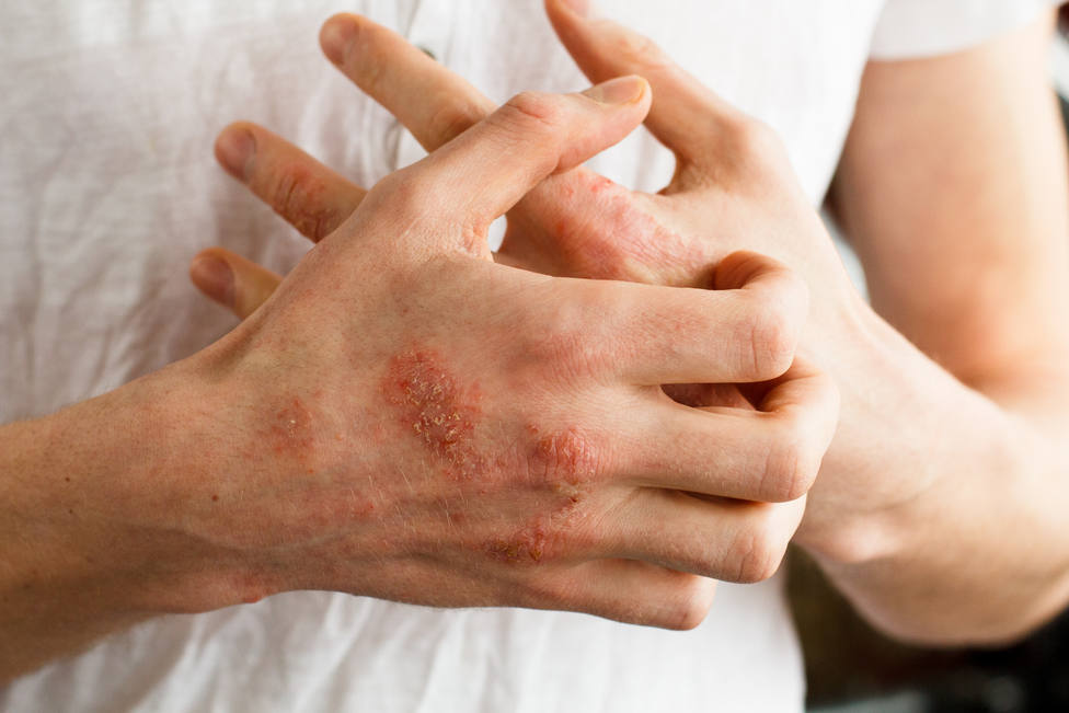 Lesiones en la piel